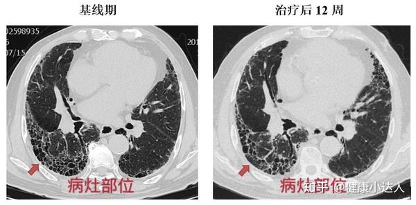 自体干细胞改善肺功能及结构治疗肺纤维化