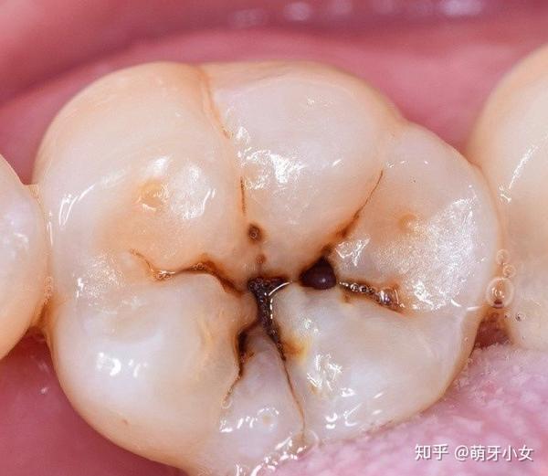3,蛀牙继续向下发展侵犯到牙髓,这时候就出现明显的疼痛,龋洞更大