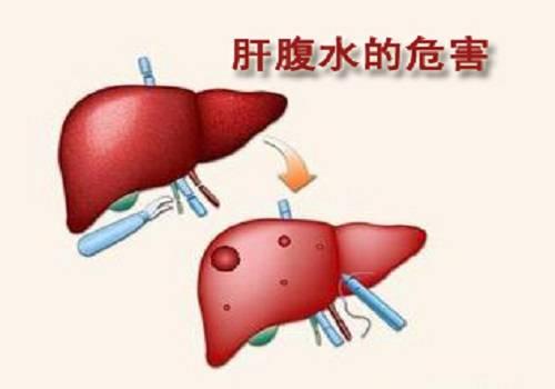 乙肝病人发生肝硬化腹水后会带来什么危害