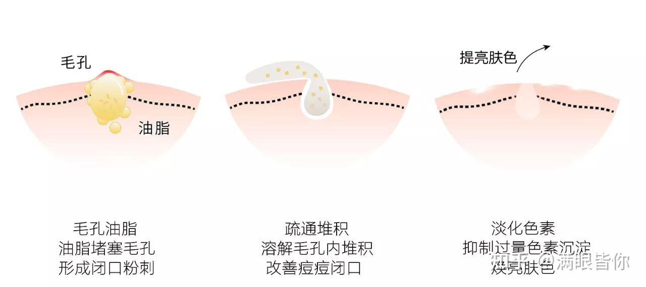 想提问刷酸对于收缩毛孔作用大不大刷哪种酸好些