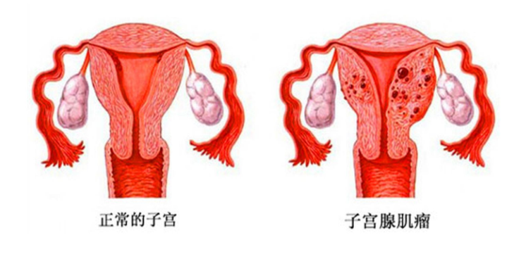 如何区分子宫肌瘤子宫腺肌症