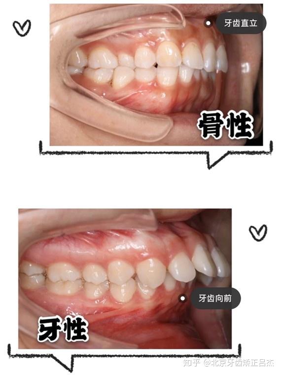 不同类型,不同程度的龅牙治疗方法也不相同:牙性龅牙,一般利用正畸