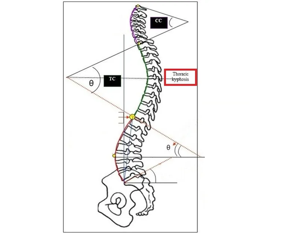 图上的"θ"角,就是胸椎后凸的角度.