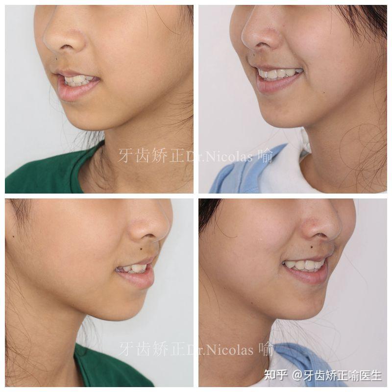 接近阻萌转态的上颌恒尖牙与排列不齐的下颌尖牙,矫正后排列至牙弓中