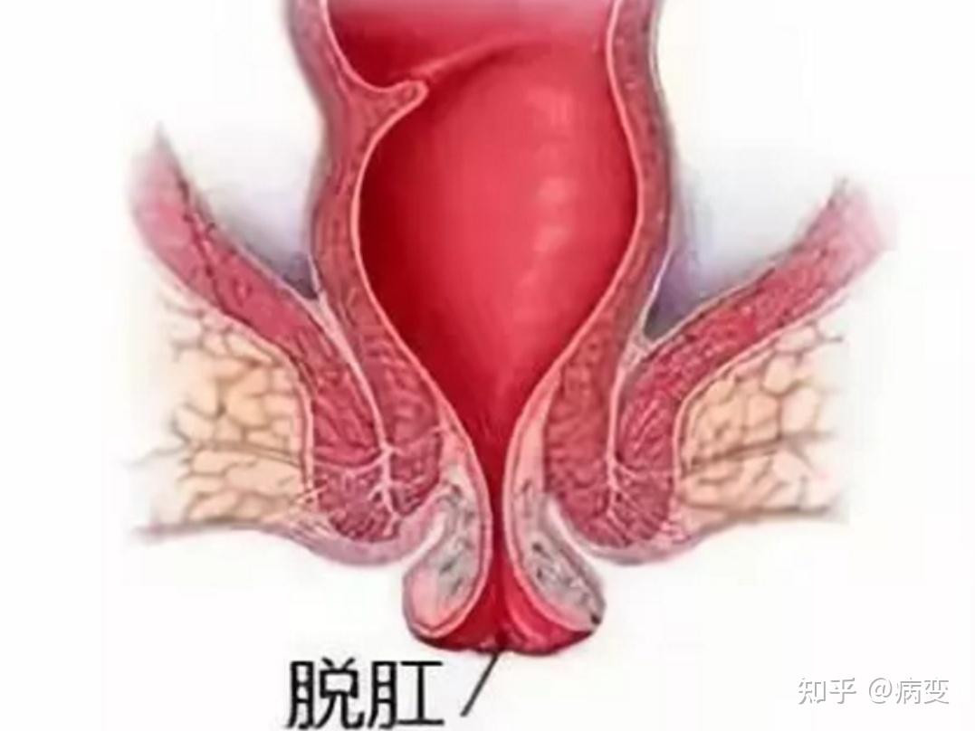 有痔疮患者用过马应龙痔疮膏吗效果怎么样