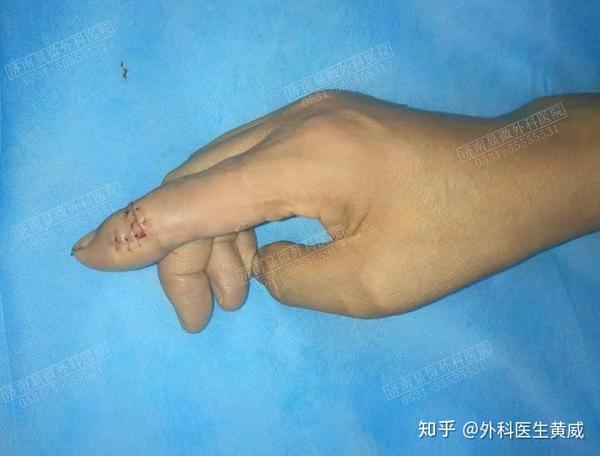 手指缺损修复方法