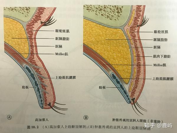 想做双眼皮手术种类那么多我该选哪种