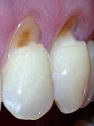 浅谈牙颈部缺损关于楔状缺损与酸蚀症