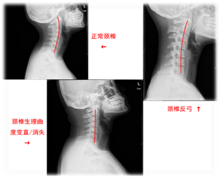 颈椎病的3种检查两种治疗方法医生想告诉你的小知识