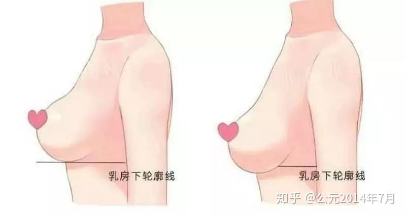 乳房下垂会产生什么影响?