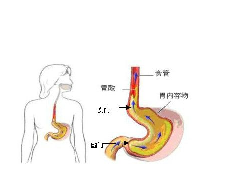 胃食管反流危害大,三种食物不能吃,常吃将加重病情诱发咽炎