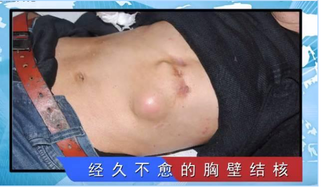 跟着医生去采访"胸壁结核"患者赵海!