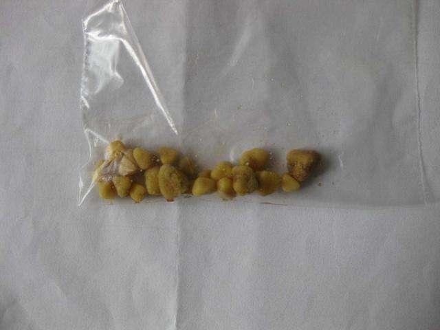 不要问我从哪里来反正我叫肾结石