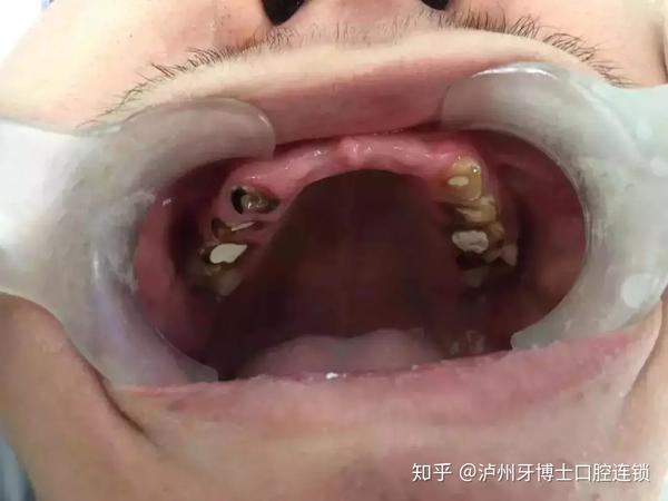 28颗牙齿拔掉8颗折断10颗 男孩的这28颗牙齿,其中上门牙6颗,下磨牙2颗