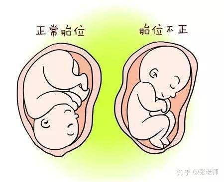 胎位臀位是什么意思?有什么危害?