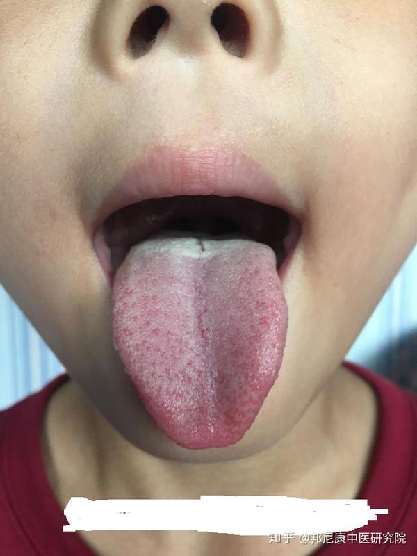 一般舌前为心肺,中间为脾胃,两侧为肝胆,我们讲舌后跟为肾,膀胱,大