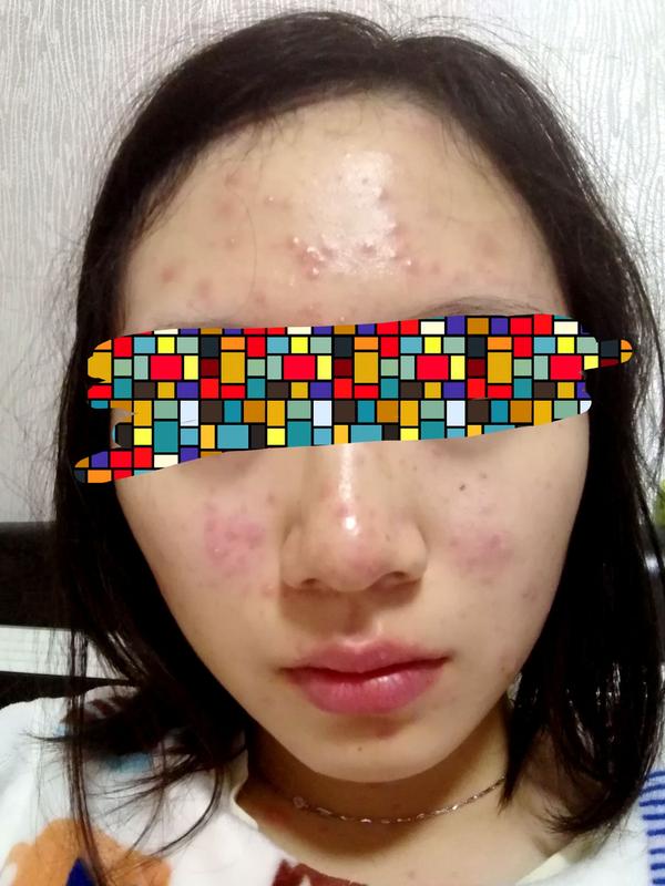 长水痘是一种怎么样的体验?