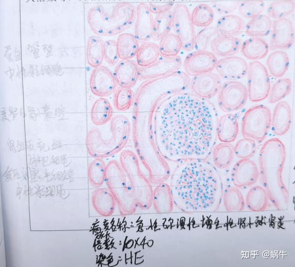 慢性肝淤血 ,急性蜂窝组织性阑尾炎(肌层),皮肤高分化鳞癌,风湿性