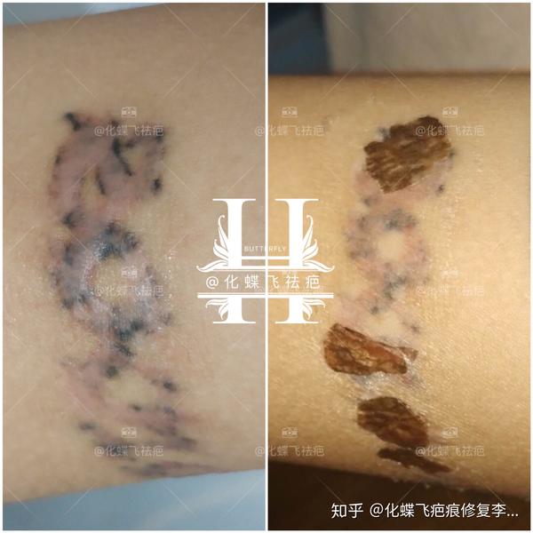 广东梅州洗纹身增生疤痕修复