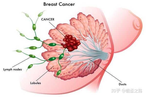它和普通乳腺癌一样