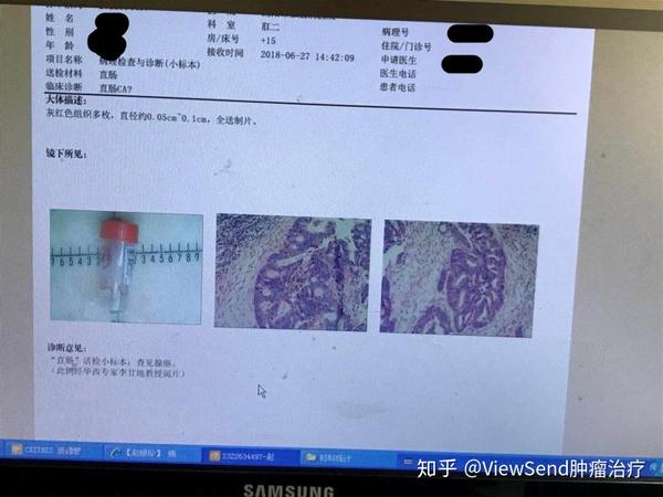 人工肛门,直肠癌患者难以诉说的苦楚