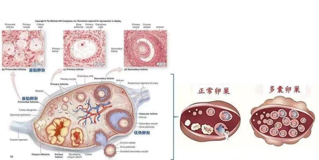 多囊卵巢综合征(pcos)与子宫内膜病变的关系