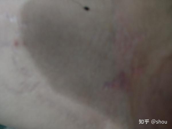 大腿内侧有条纹一年了请问这到底是股藓还是肥胖纹