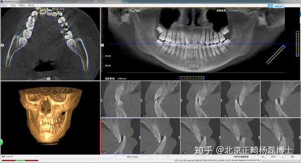 (2)正位x线头影测量分析:用来分析颌面骨骼横向关系,左右对称性,中线