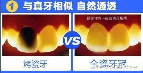 烤瓷牙和全瓷牙有什么区别 烤瓷牙和全瓷牙哪个好{杭州}