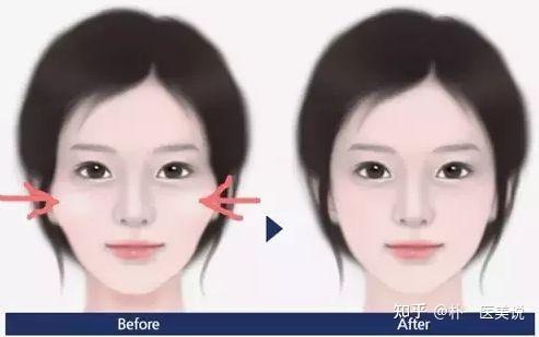 请问我的脸又大又宽又方是因为咬肌大还是下颌骨大