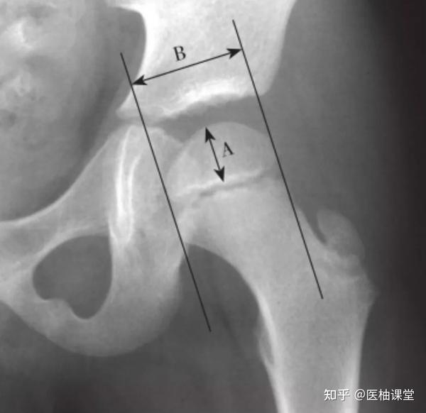 骨骺指数与骨骺商 在髋关节正位片上,分别测量股骨头骨骺的高度和