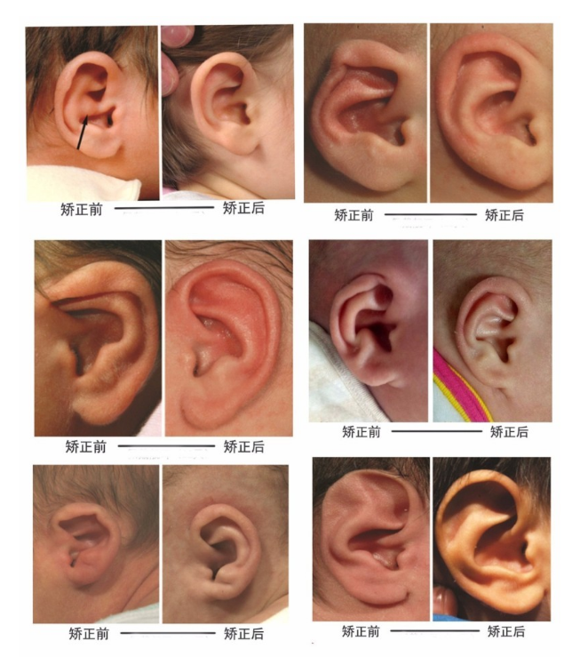 小耳科普六十九新生儿耳朵缺陷是何原因