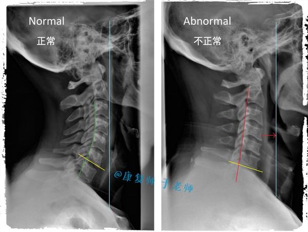 因为正常人的颈椎一般来说是有一定的 前凸的,生理曲度对维持颈椎正常