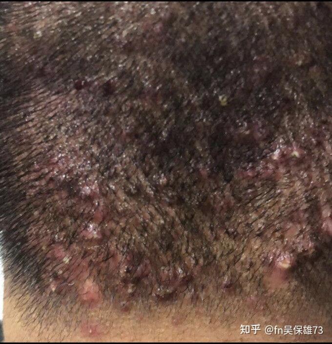 有什么可以彻底根治头皮毛囊炎的方法