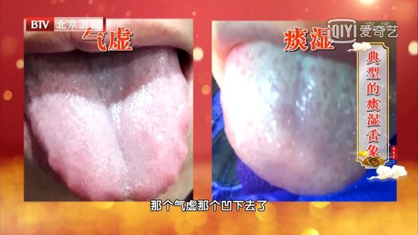 你舌头的样子,暗示着各种疾病隐患,甚至是癌变!赶紧自查