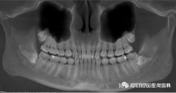 cbct显示:18,28高位埋伏阻生,牙根紧邻上颌窦;38,48低位水平完全骨