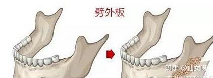 虽然劈外板可以提高术后效果,但也不是人人都需要做的