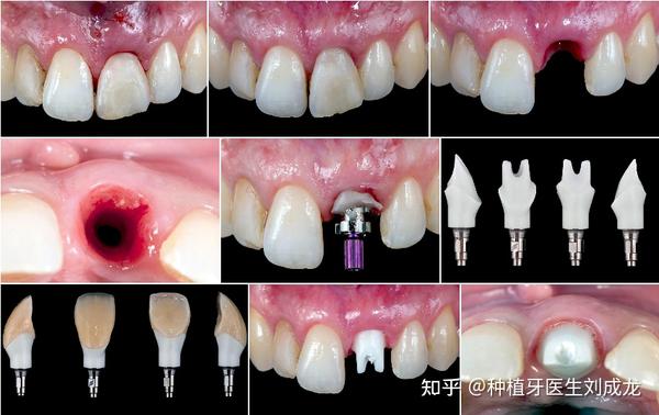 郑州瑞士iti种植牙费用多少