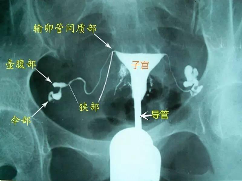 做完输卵管造影什么时候可以同房