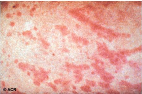 有部分病人为荨麻疹样斑疹,因瘙痒而抓挠者更常见荨麻疹样改变.