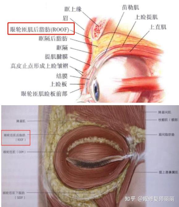 是位于眼轮匝肌和眶隔之间,和眉部的额肌下脂肪结构是连接在一起的