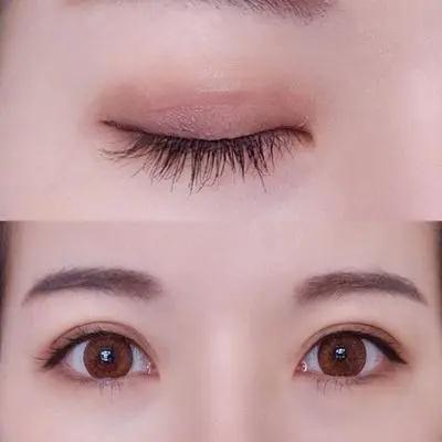 首先埋线 埋线的术式是通过缝合的方式来达到双眼皮的效果 它的优点是