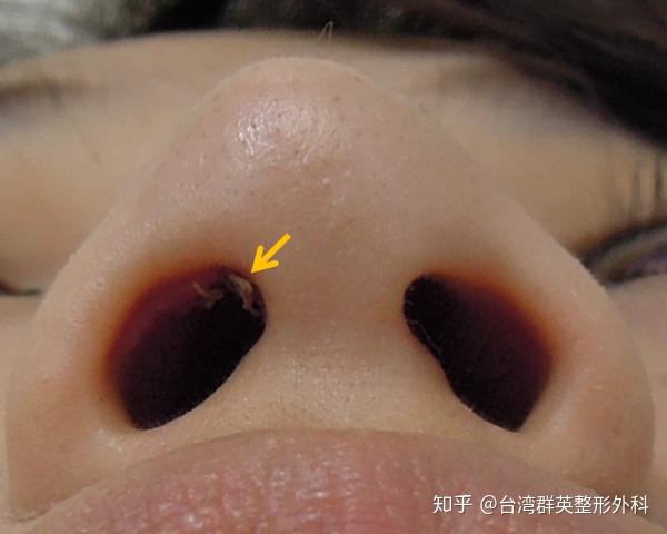 接受内开式隆鼻手术,箭头指出鼻孔内缝线(约2周拆线)伤口位于鼻孔内