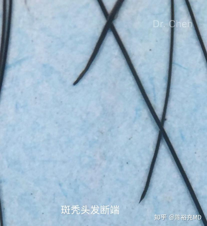 生长期头发根部也有白点,但不是杵状,它的白点更长更大.