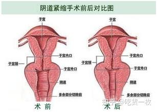 1, 阴道紧缩术:通过手术的方式将盆底肌收紧,从而缩小阴道的宽度,可以