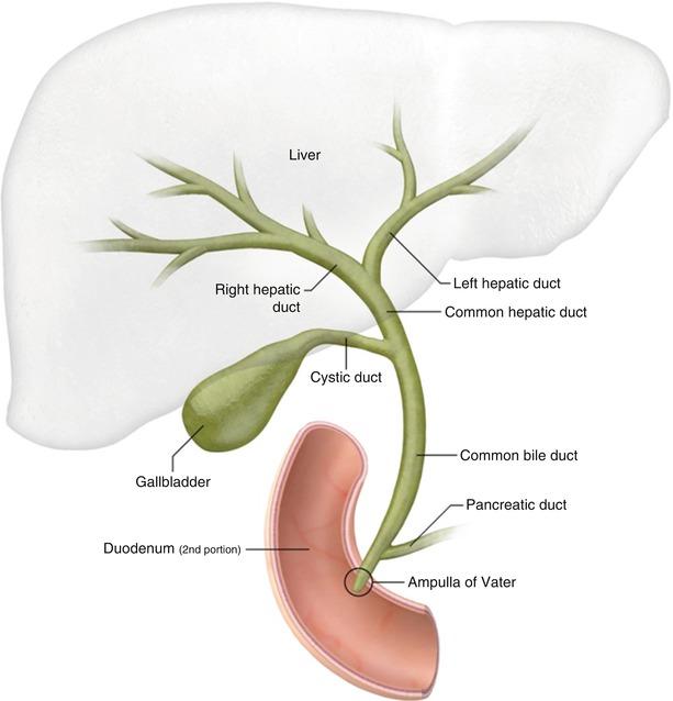 肝内胆管结石典型病例:右后叶肝内胆管结石,胆囊结石