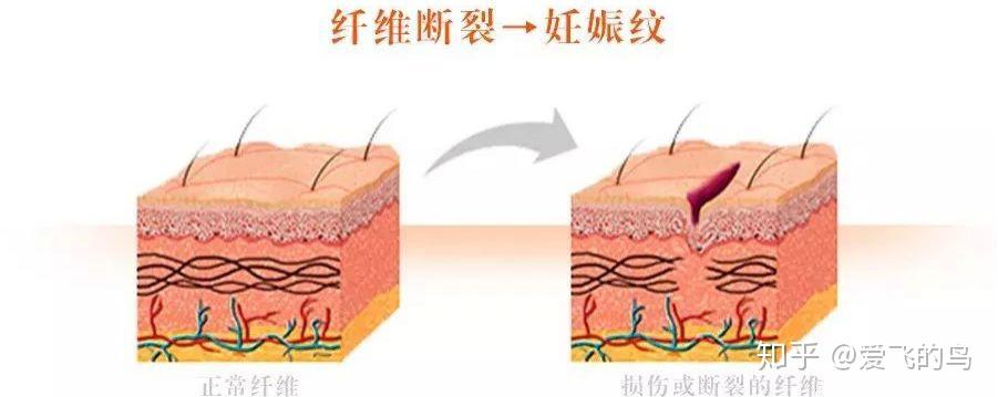 皮肤受到迅速拉伸导致皮肤纤维(弹性纤维和胶原纤维)断裂,从而使皮肤