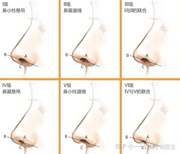 隆鼻手术汇总什么样的海鸥线才是最好看的?