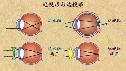 物体成像的焦点落在视网膜偏后的位置; 近视是物体成像的焦点落在