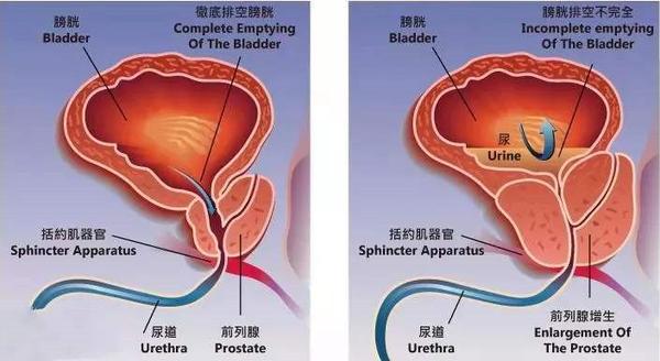 前列腺增生患者平时应该注意些什么,才能避免出现排不出尿,尿潴留的